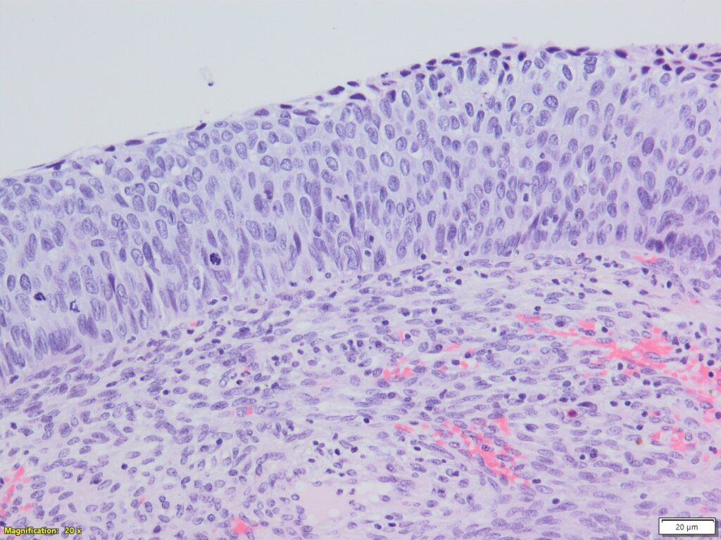 A sample of a cervix with CIN3 (high grade abnormal cells)
