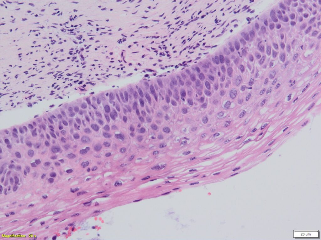 A sample of a cervix with CIN1 (low grade abnormal cells)