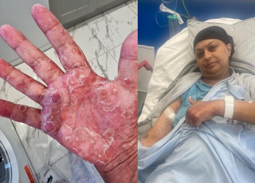 Two pictures (left) Sbba's hand with rash and burn. (right) Sbba in hospital bed.