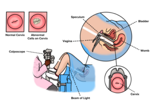 Cervical screening results - The Eve Appeal
