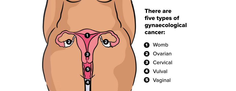 Body showing gynae anatomy. Text says 'There are five types of gynaecological cancer: 1 Womb, 2 Ovarian, 3 Cervical, 4 Vulval, 5 Vaginal