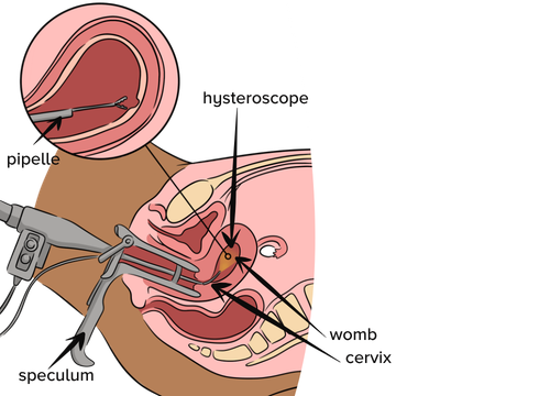 An illustration Hysteroscopy (with biopsy) showing a female lower body from the side angle with internal organs showing to visualise inside, a speculum with a hysteroscope attached shown entering the womb and a zoomed in image of lining of womb and pipelle. Labels and arrows pointing to: Hysteroscope, womb, cervix, speculum, pipelle.