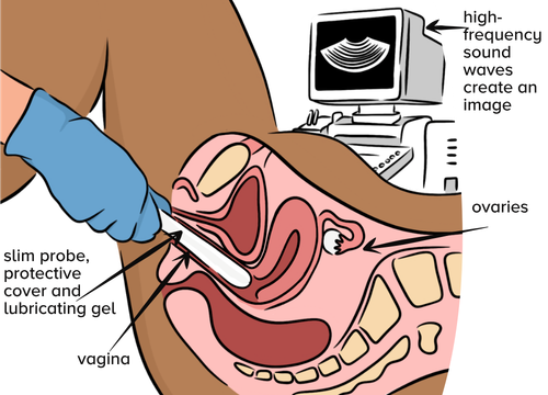 An illustration showing a Transvaginal ultrasound of a female lower body laid down from side angle with internal organs showing to visualise anatomy inside, hand wearing medical glove holding ultrasound probe and image of computer in background. Arrows and labels point to: slim probe, protective cover and lubricating gel, high-frequency sound waves create an image, vagina and ovaries.