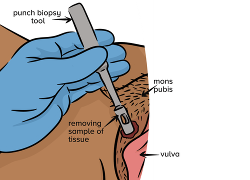An illustration of a vulva and pubic hair with a hand wearing a medical glove and punch biopsy instrument taking a biopsy of skin. Arrows with labels pointing to: punch biopsy tool, mon pubis, vulva and removing sample of tissue.