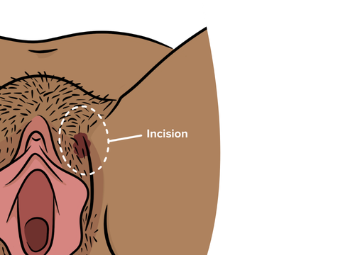 An illustration showing wide local excision of a vulva, pubic hair and an incision that is circled with label 'incision'.